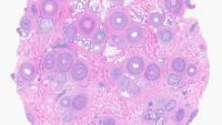 Microscope imaging of a scalp biopsy of alopecia areata